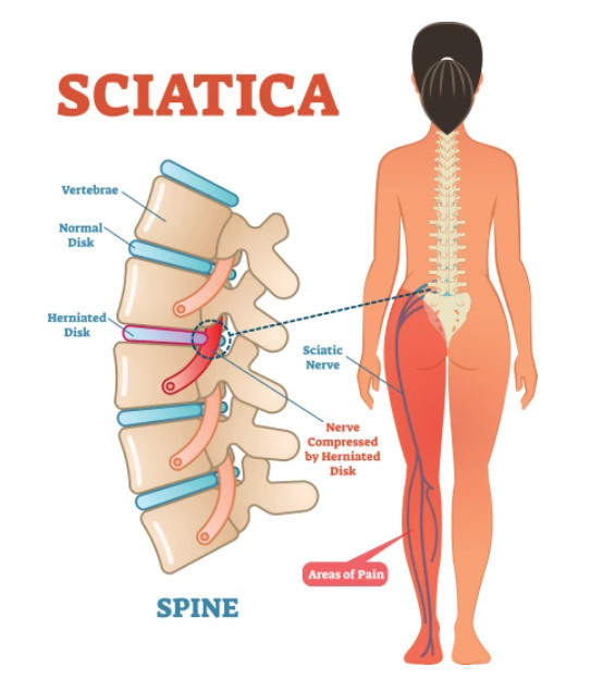 Sciatica