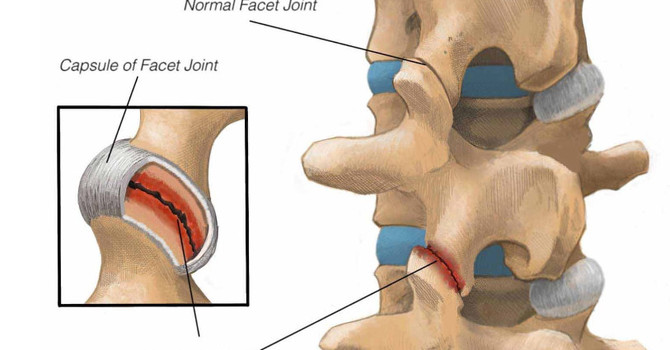 Why Does My Low Back Hurt When I Walk or Stand? image