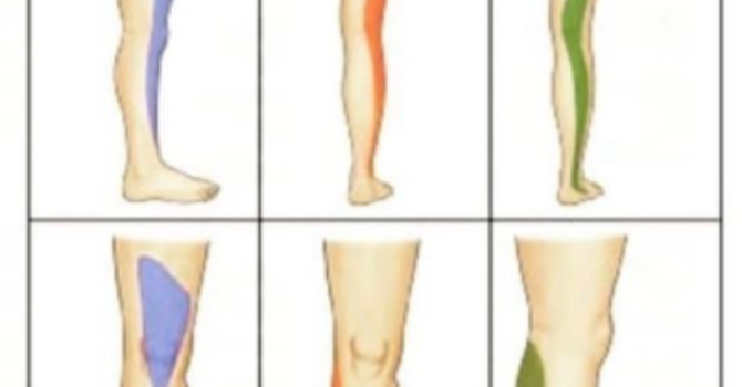 Understanding L4/L5 Disc Bulges and Radicular Pain image