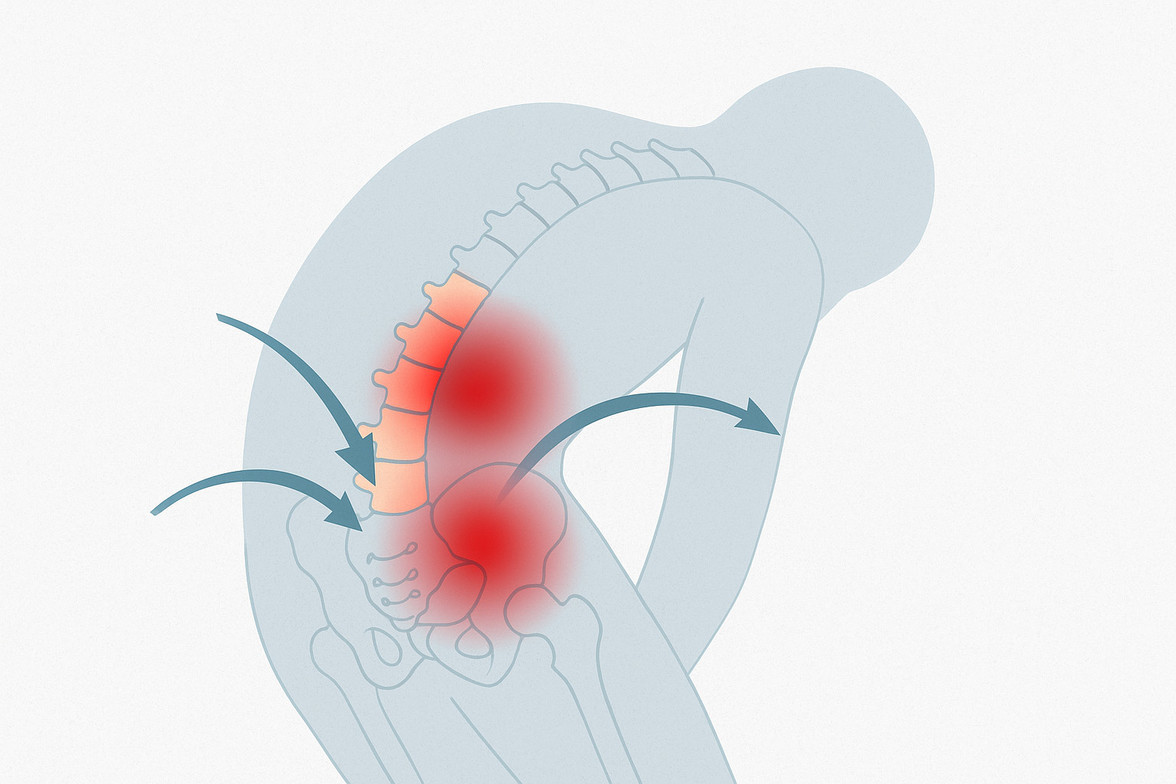 Simple lumbar spine diagram showing stress patterns contributing to unexplained low back pain, used by Woodroof Chiropractic in Olathe.