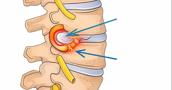 Understanding Disc Bulges and Chiropractic Treatment Options image